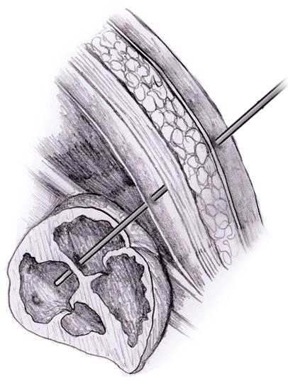 emvryakh xeiroyrgikh gia tis diataraxes diaplsh ths kardias 05