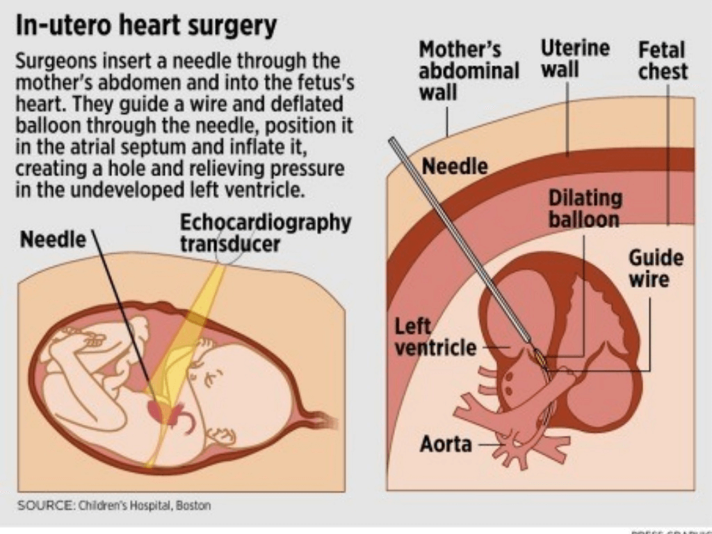 emvryakh xeiroyrgikh gia tis diataraxes diaplsh ths kardias 05